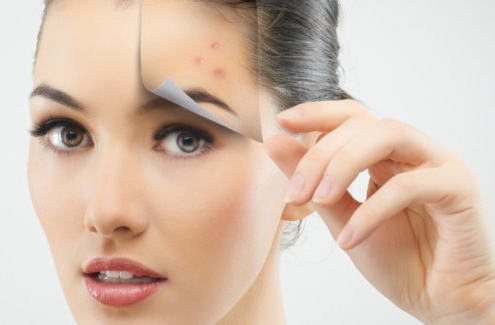 Safest Way to Remove Pimples without Leaving Scars